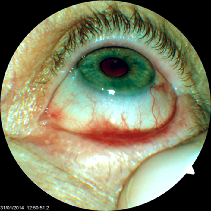 Ocular Mucous Membrane Pemphigoid The Importance Of Early Detection And Treatment Eye News