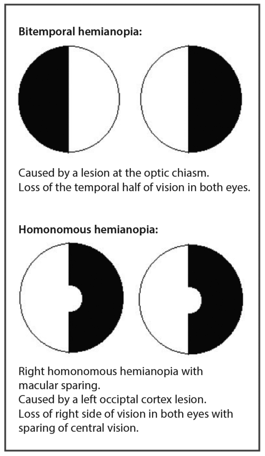 Visual Field Defects Chart