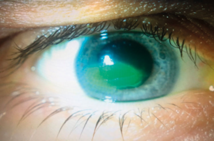 Persistent epithelial defect that failed with conventional management.