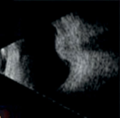 Typical dome-shaped choroidal lesion on B scan ultrasonography