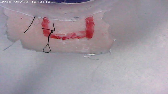 Photo of a trabeculectomy flap marked in red with releasable suture in situ