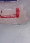Photo of a trabeculectomy flap marked in red with releasable suture in situ