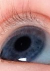 Photo showing anterior polar cataract diagnosed around eight weeks of age