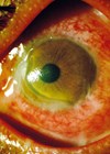 Gonococcal conjunctivitis in the left eye photo