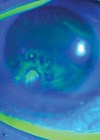 Photo showing fluorescein staining showing abnormal uptake suggestive of recurrent corneal erosion. 