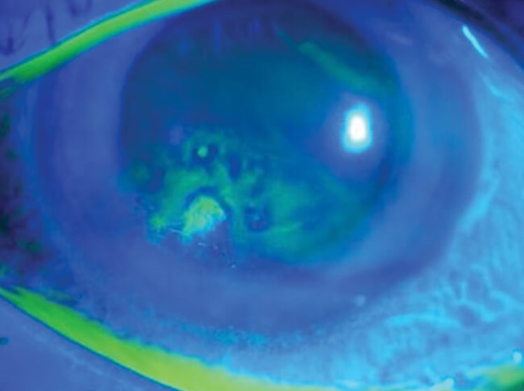 Punctate Abscess Punctate Epithelial Erosions