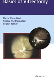 Basics of Vitrectomy book cover image.