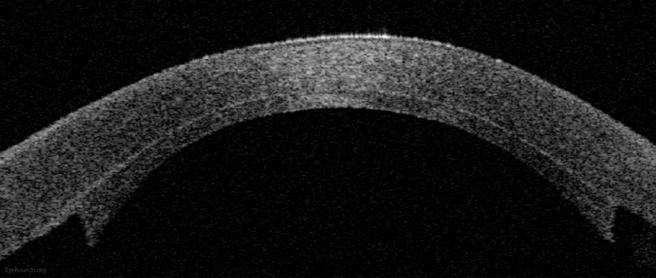 Anterior segment optical coherence tomography demonstrating an attached  DSAEK graft one day after surgery.