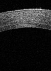 Anterior segment optical coherence tomography demonstrating an attached  DSAEK graft one day after surgery.