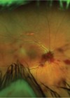 Widefield Optos retinal colour photography of the right eye.