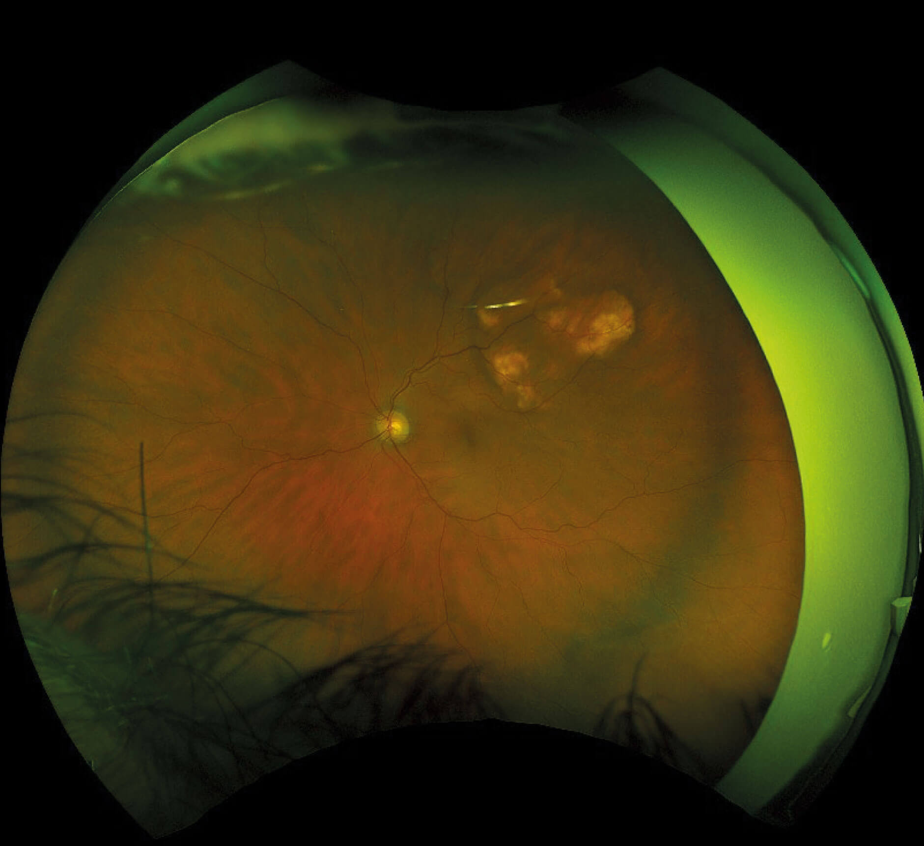 Sclerochoroidal calcification on Optos fundus photograph in the left eye.