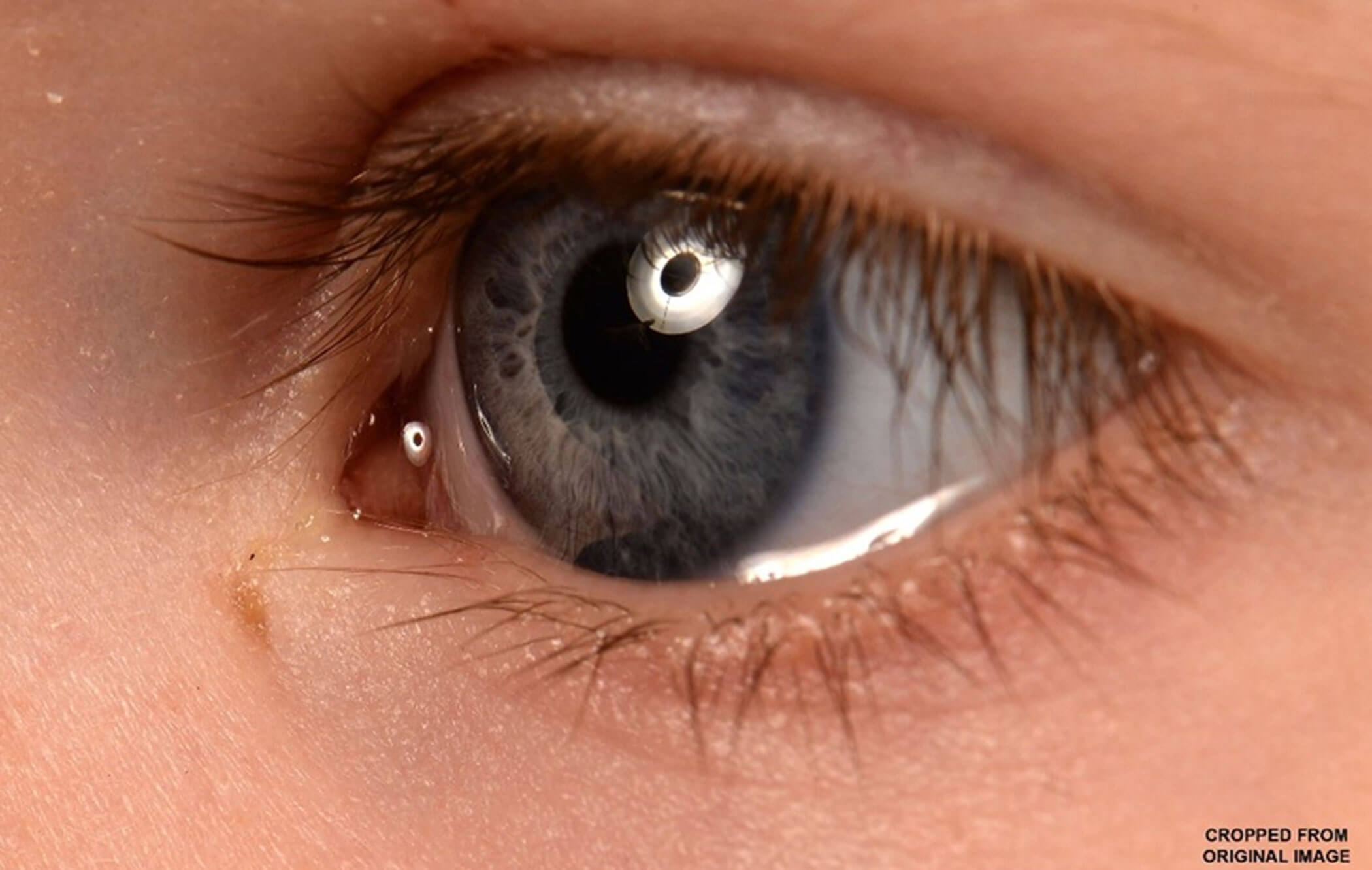 Photo showing small pit / hole located inferonasal to the medial canthal angle of the left eye. 