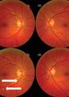 Fundus examination of first case of vision changes from long-duration spaceflight. 