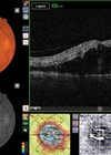 An optical coherence tomography (OCT) scan of a branch retinal vein occlusion (BRVO).