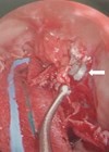 Image of left transnasal endoscopic view showing the airgun pellet located in the orbital apex.