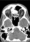 CT scan showing hyper-ossification of the frontal sinus wall with reduction of expansion of the sinus. 
