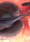 Photo showing how the body of pterygium is grasped, and subconjunctival dissection done with Vannas scissors from forniceal approach.