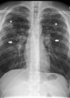 Chest X-ray showing nodular lung infiltrates (white asterisks) and bilateral hilar prominence (white arrows).