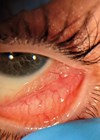 Photo showing conjunctival emphysema in the inferior temporal conjunctival fornix.