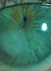 Image showing stromal keratitis with anterior stromal involvement and superficial vascularisation.