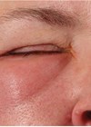 Photo showing right eye periorbital edema – anterior view. 