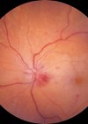 Left fundus photograph showing CRVO with blurred disc margin.