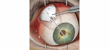Valveless Glaucoma Drainage