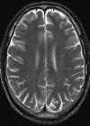 Picture showing contrast magnetic resonance imaging.