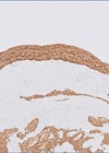 Image showing representative H+E-stained sections and glial fibrillary acidic protein (GFAP) immunohistochemistry of the lesion.