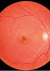 Right-eye (OD) fundus image showing pigmentary changes at the fovea.