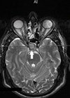 Image showing MRI head showing a well-defined sellar mass.