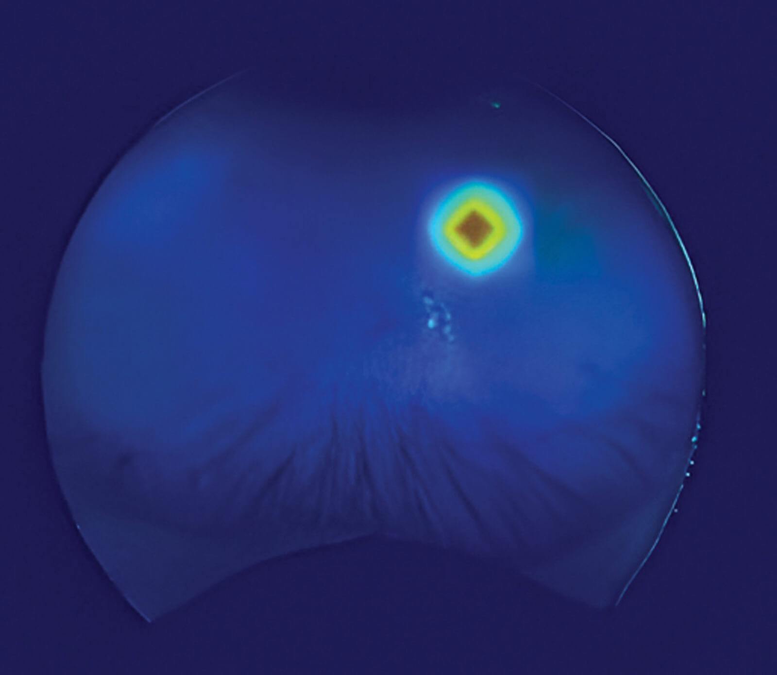 Class activation map showing the models prediction of a freckle being present.