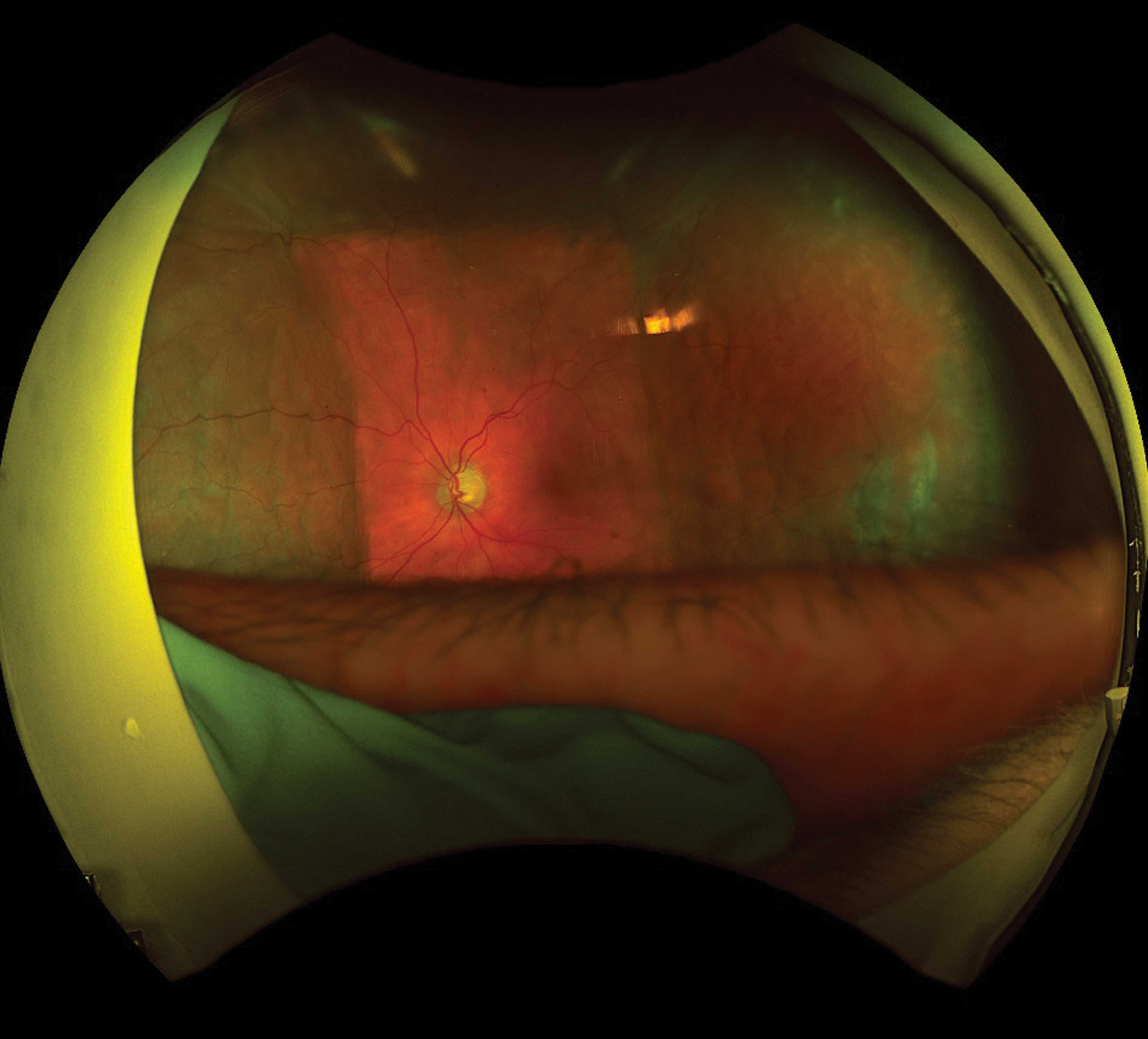 Ultra-widefield imaging photo - week 6.