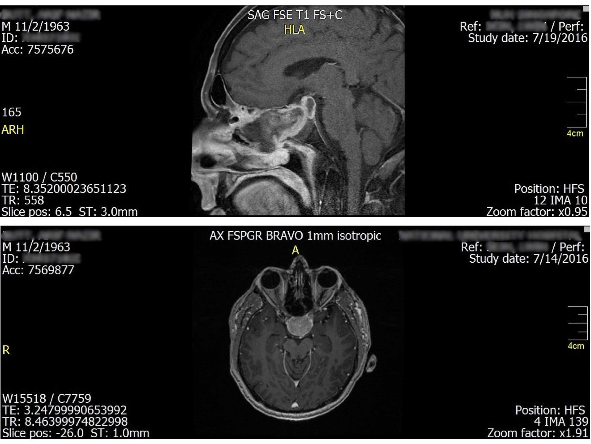 Images showing Gadolinium-enhanced MRI (T1-weighted sagittal and axial views) showing a 2.9 × 2.8 × 2.8 cm homogeneously enhancing pituitary macroadenoma compressing the optic chiasm.