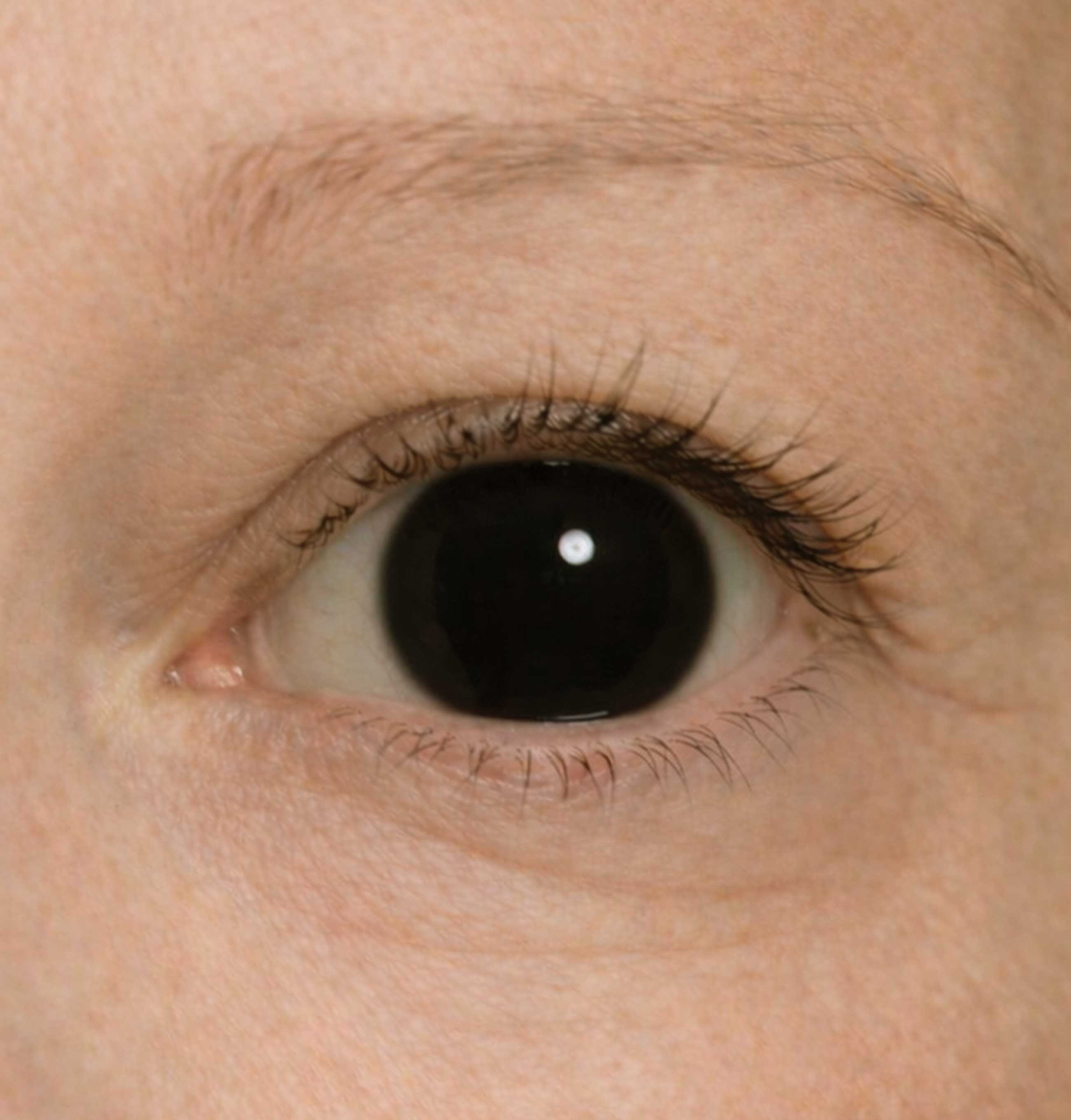 Anonymised close-up image of the patient’s eyes demonstrating marked unilateral mydriasis of the left pupil compared with a normal right pupil.