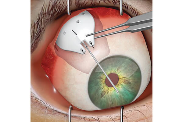 Exclusive Glaucoma Products