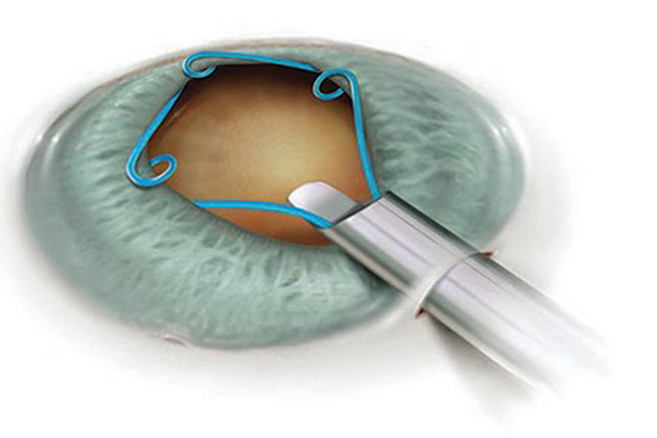 Iris Expansion Simplified