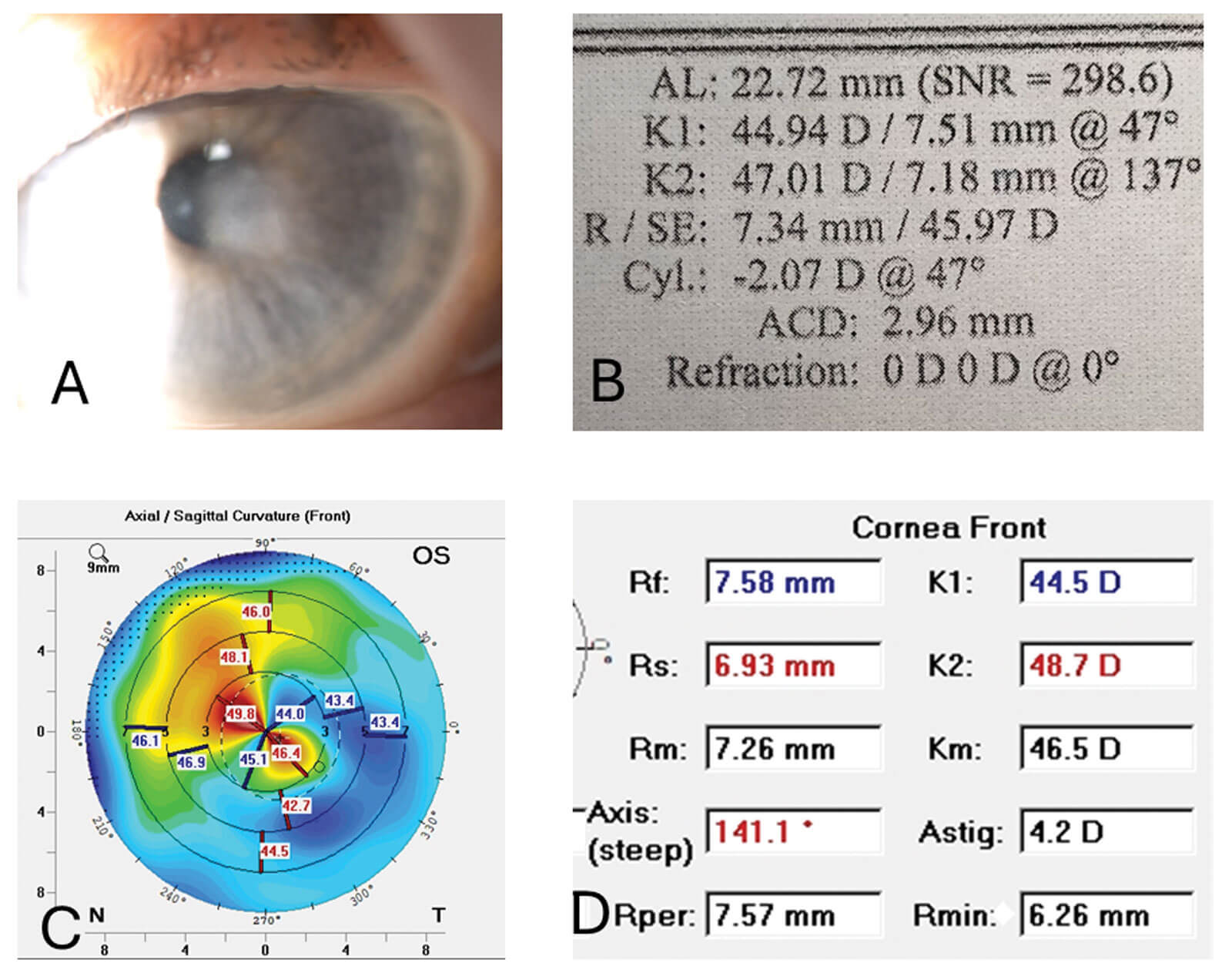 Images showing irregular(ish) astigmatism.
