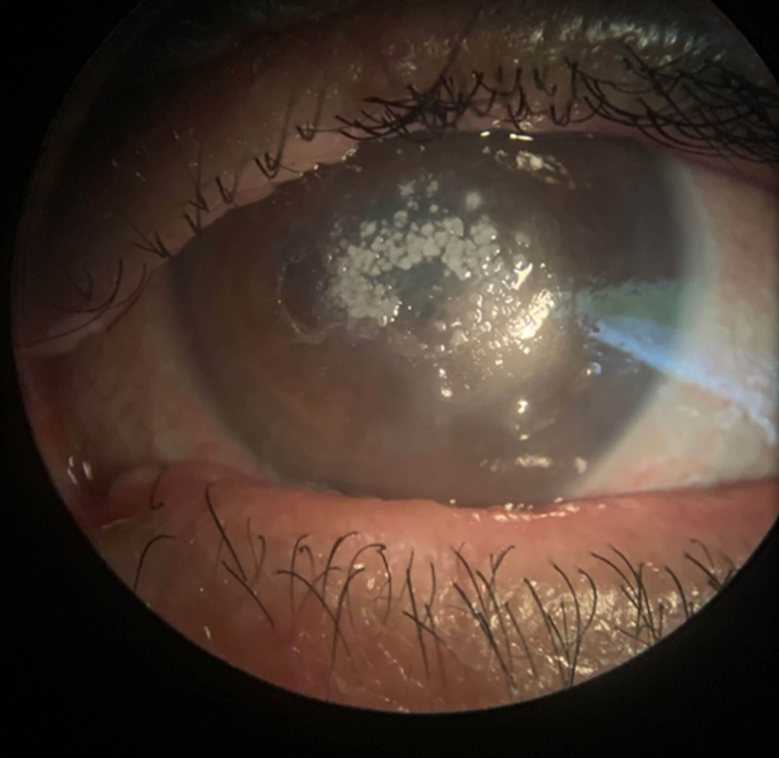Image showing candida keratitis.