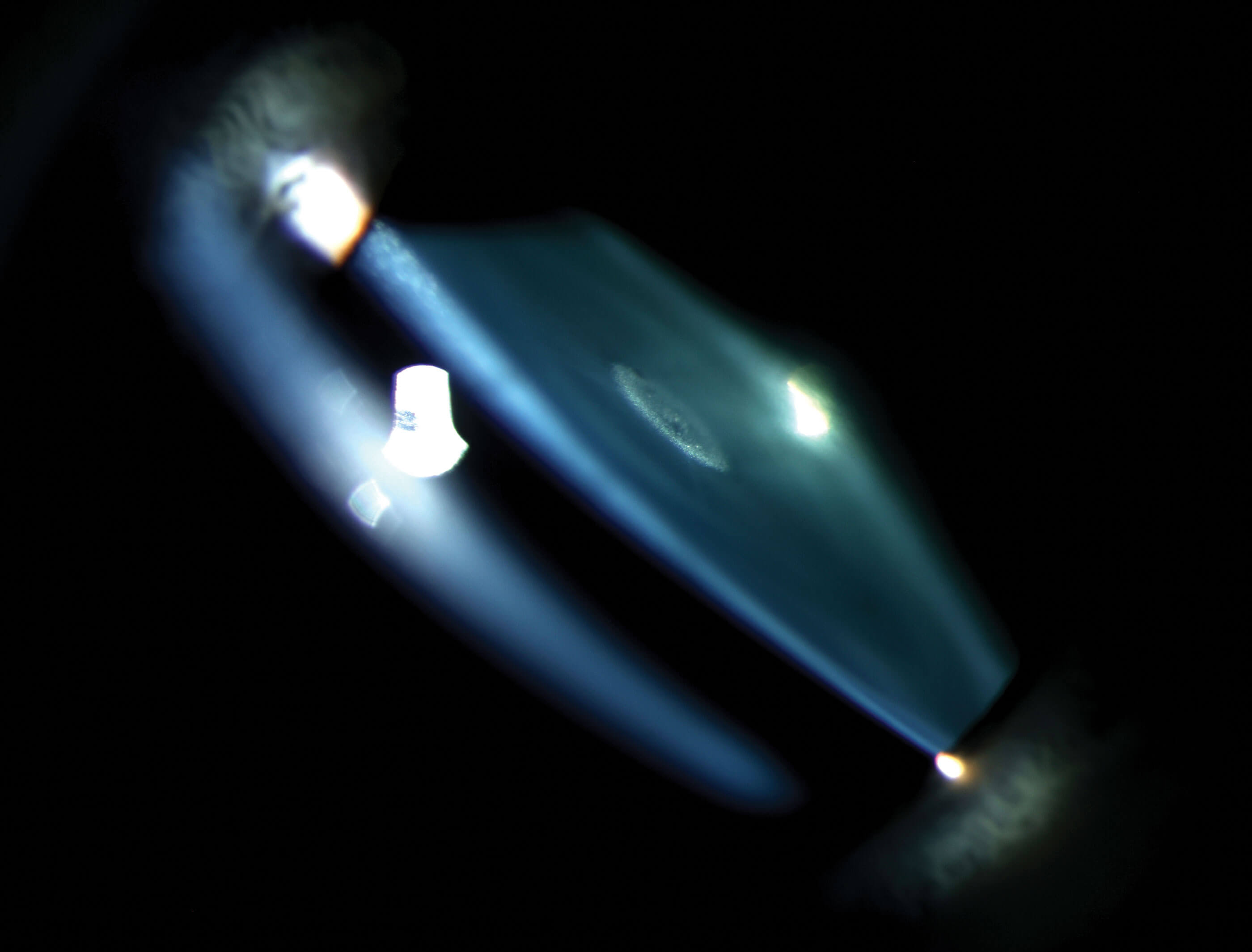 Slit lamp image with an optical section through a lens.