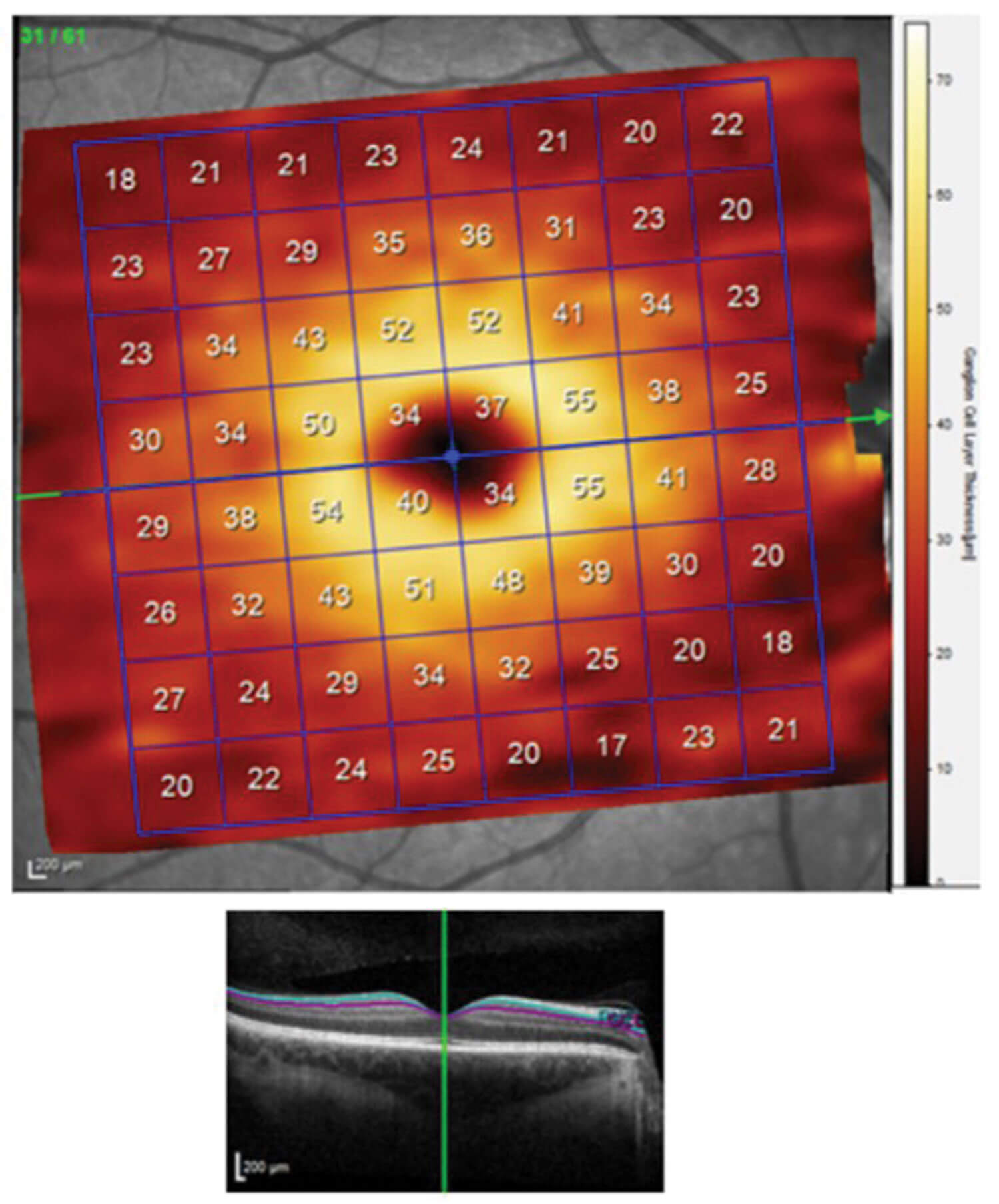 Image showing heat map of the macular ganglion cell layer showing regional thickness values (μm).