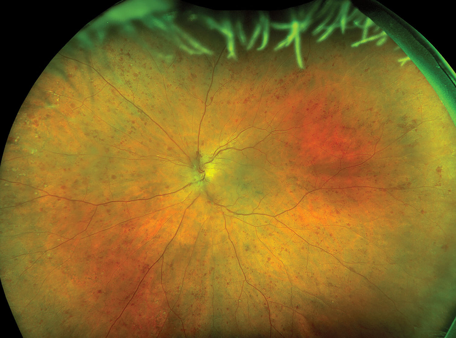 Image showing beginning of phase II, colour fundus.