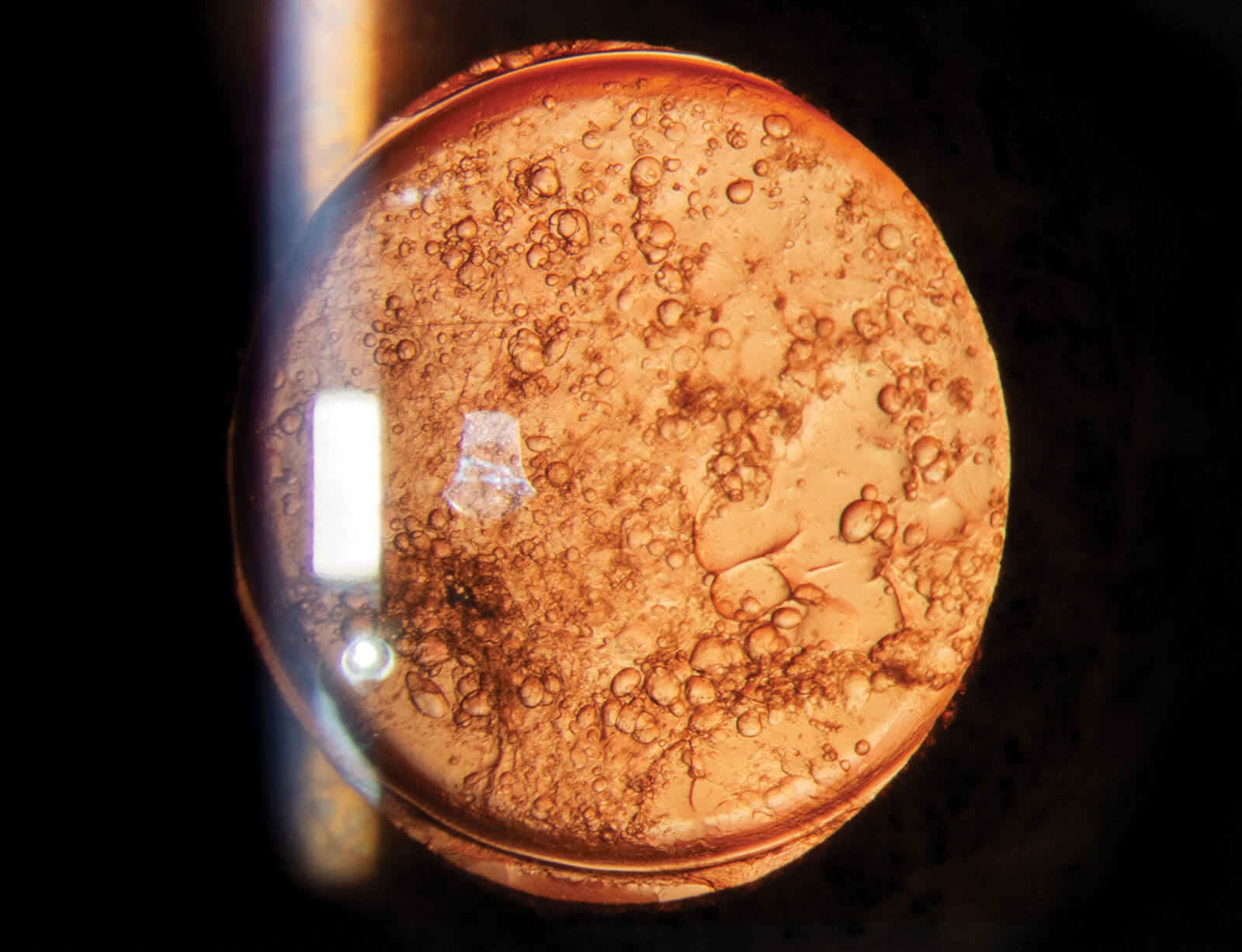ANTerior Segment 2026 Image - Posterior capsule opacification by Kim Baxter.