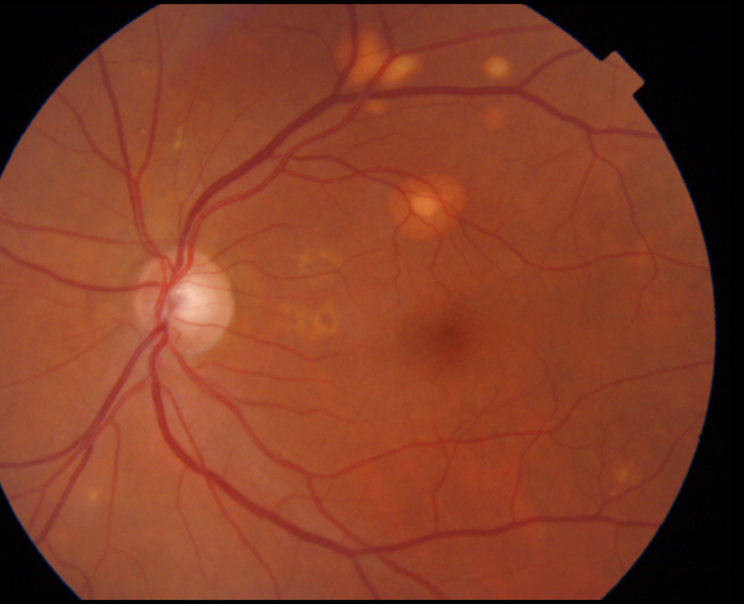 Fundus photograph.