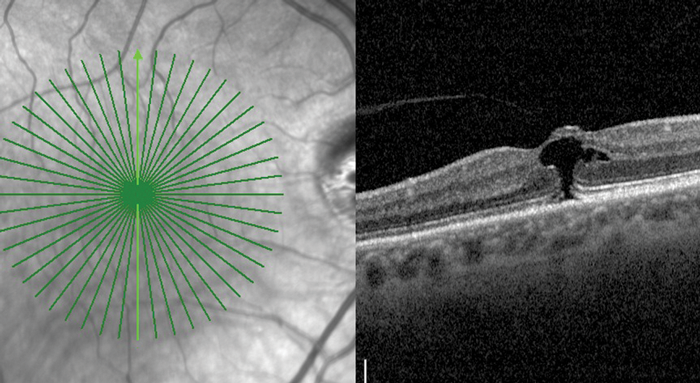 vmt retina