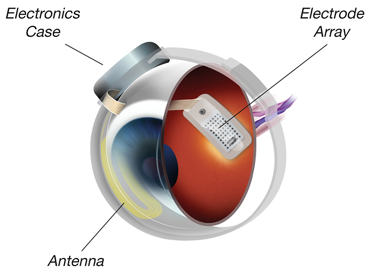 Bionic Eye