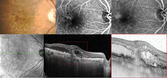 Clinical relevance of the anatomic classification of neovascular age ...