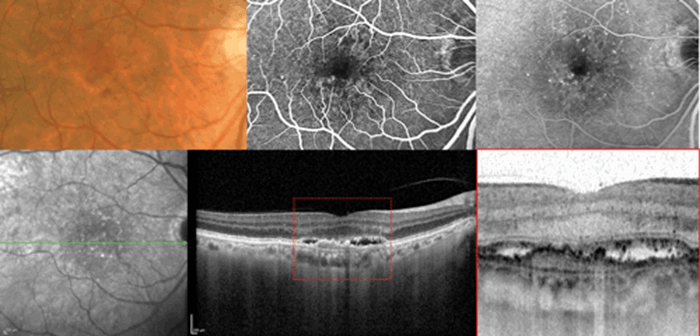 Clinical relevance of the anatomic classification of neovascular age ...